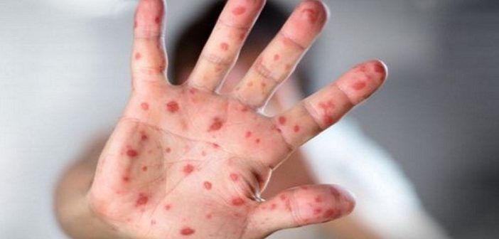 Deaths in 24 hours with measles symptoms; Increased risk of infection due to isolation