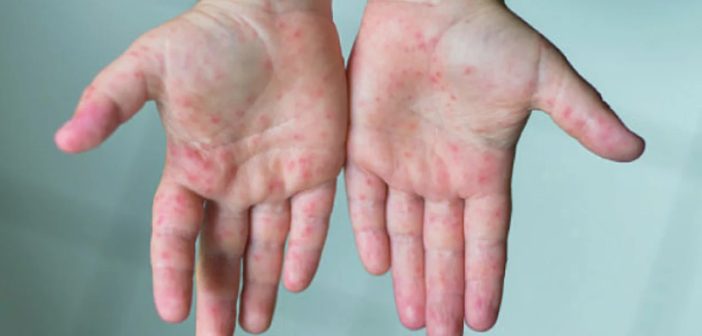 Eight children die of measles and measles in 24 hours