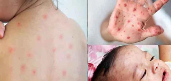 Twelve more children died of measles and symptoms in 24 hours
